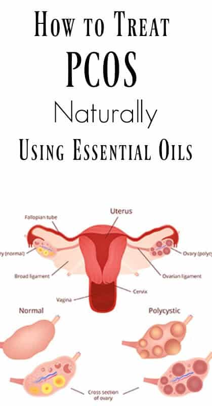 How to Treat PCOS Naturally Using Essential Oils