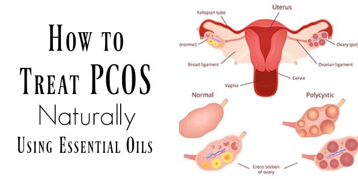 How to Treat PCOS Naturally Using Essential Oils